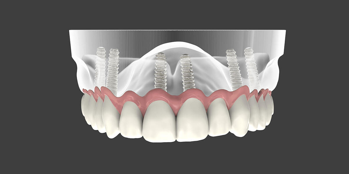 Implant Dentures