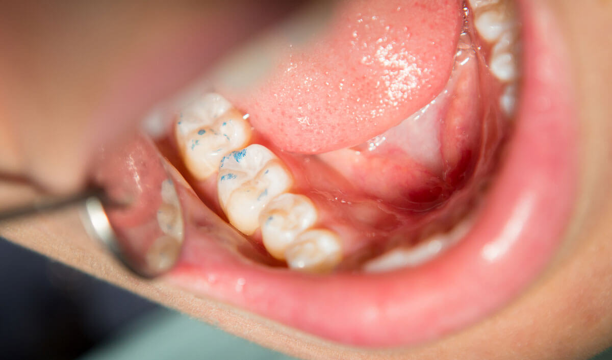 Bruxism