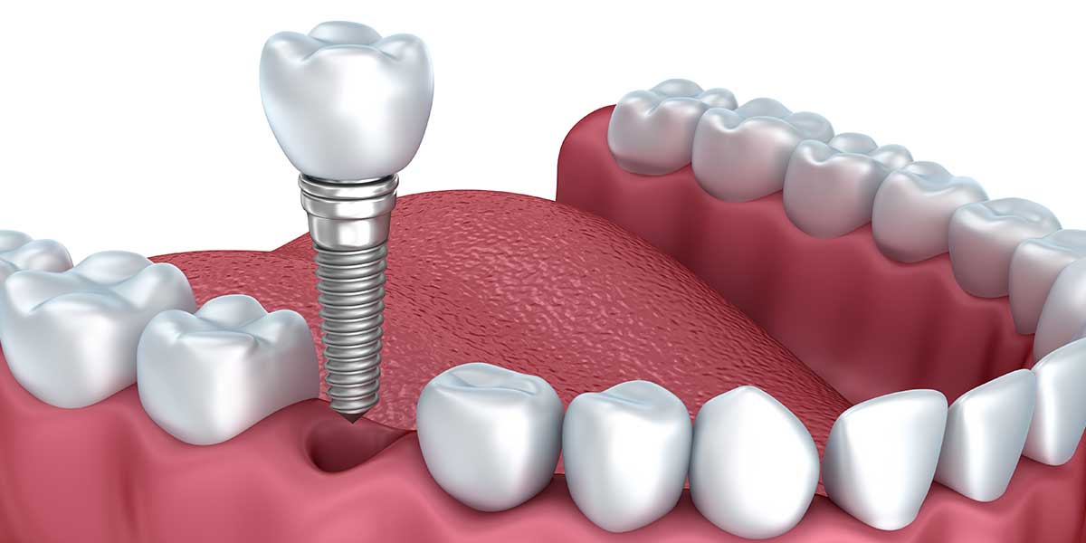 Image result for dental implants