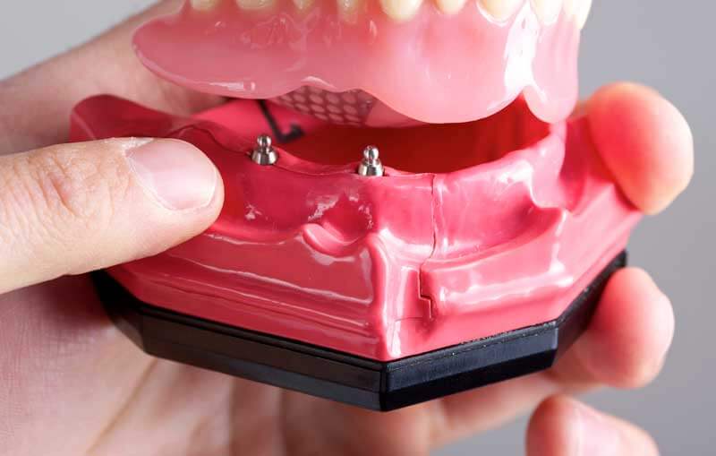 Mini Implant