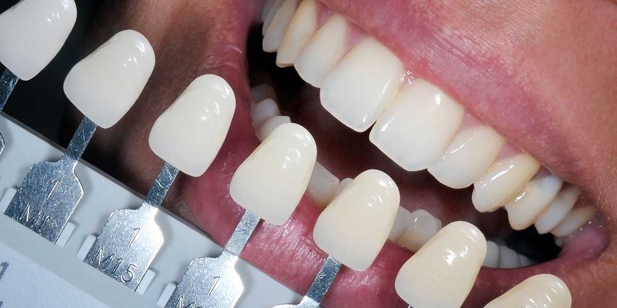 Plastic Fillings  Advantages of Composite Tooth Colored Fillings